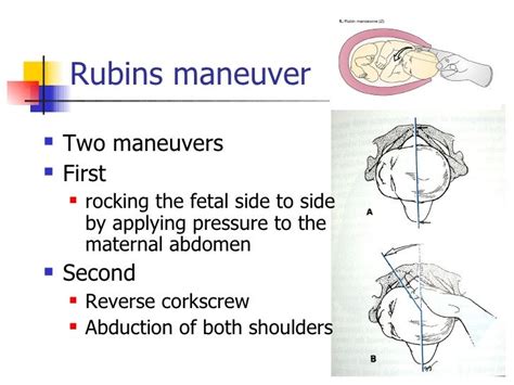 rubin maneuver.